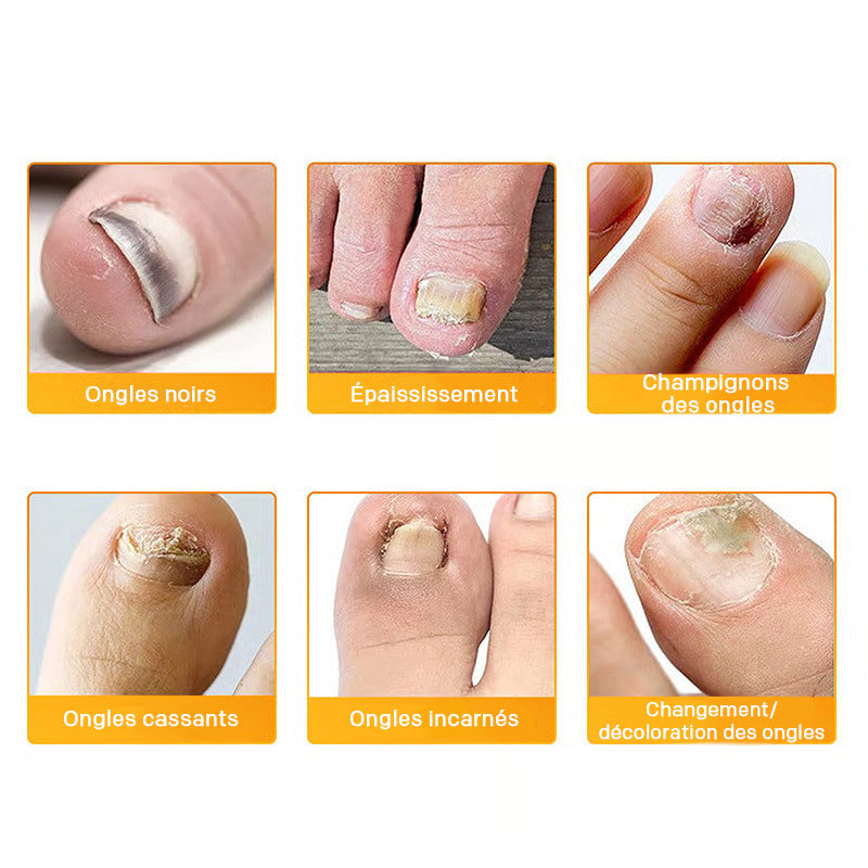 1+1 GRATIS | NagelClear Patch – Starke Nägel ohne Pilzinfektion