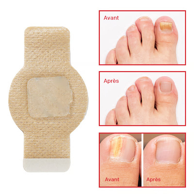 1+1 GRATIS | NagelClear Patch – Starke Nägel ohne Pilzinfektion