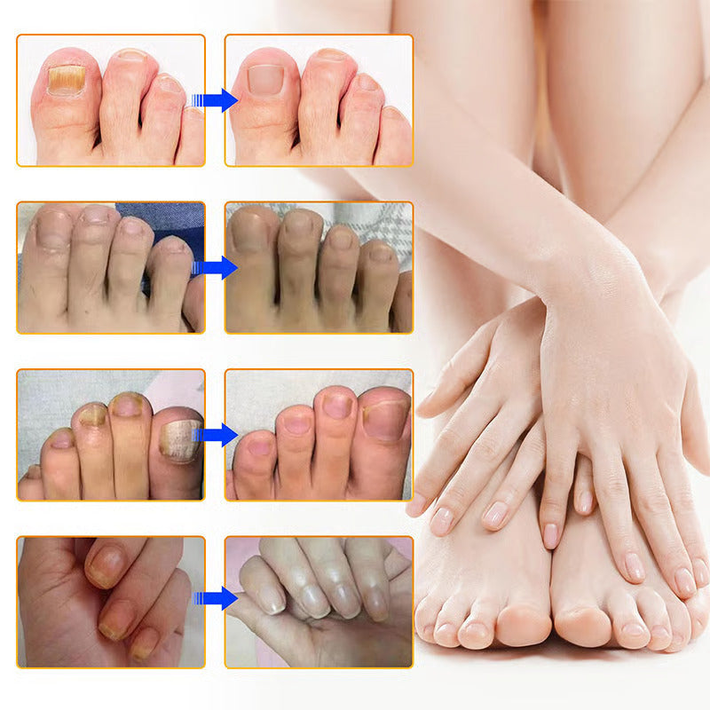 1+1 GRATIS | NagelClear Patch – Starke Nägel ohne Pilzinfektion