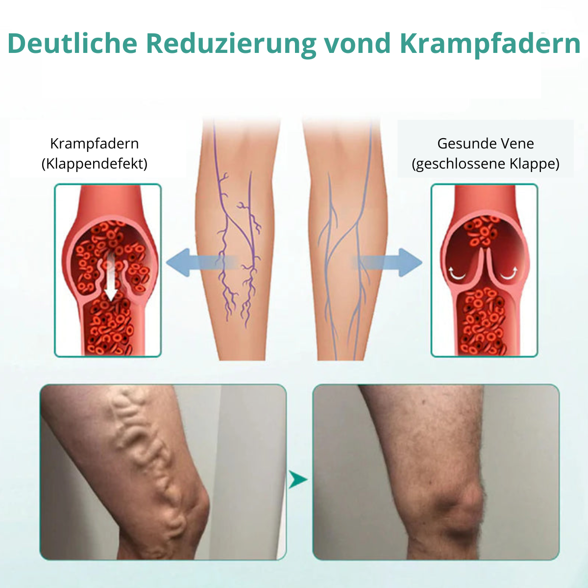 VenoLift Patch – Schluss mit schmerzhaften, sichtbaren Venen