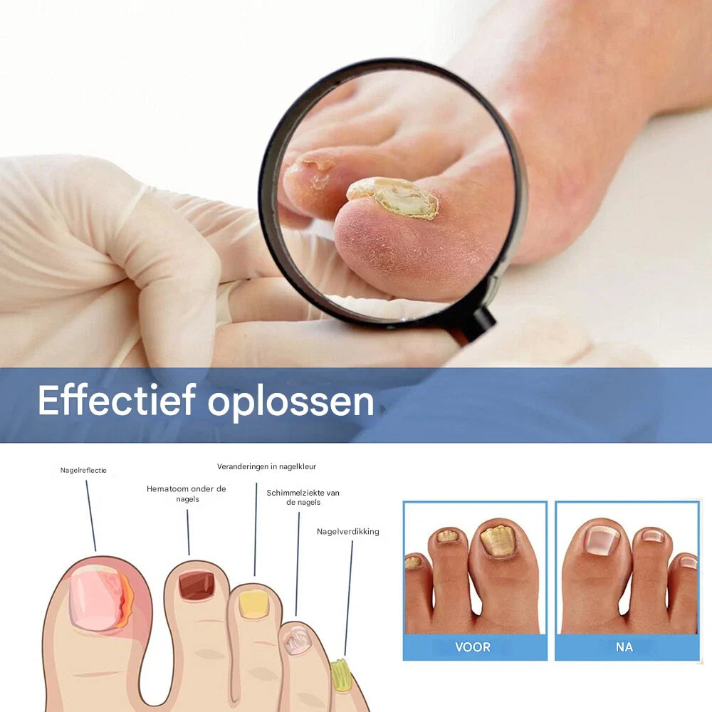 MycoClear – Für gesunde, pilzfreie Nägel